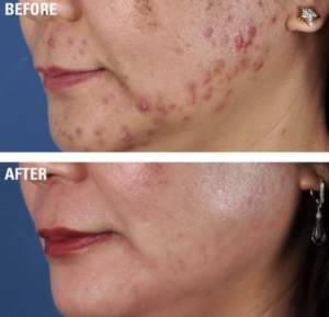 Before and after chemical peel after suffering from severe acne