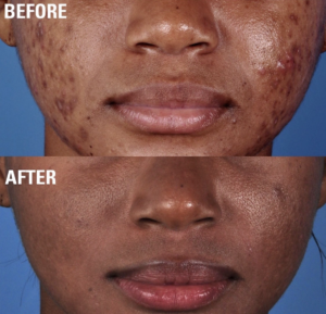 Before and after chemical peel after suffering from severe acne