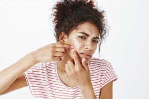 Skin care myth: popping your pimple